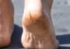फटे हुए पैरों और एड़ियों का इलाज how to Treat cracked feet and heels