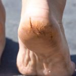 फटे हुए पैरों और एड़ियों का इलाज how to Treat cracked feet and heels