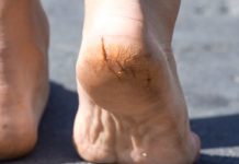 फटे हुए पैरों और एड़ियों का इलाज how to Treat cracked feet and heels