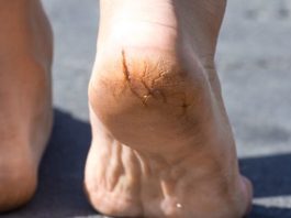 how to Treat cracked feet and heels