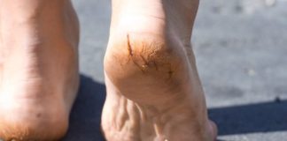 how to Treat cracked feet and heels