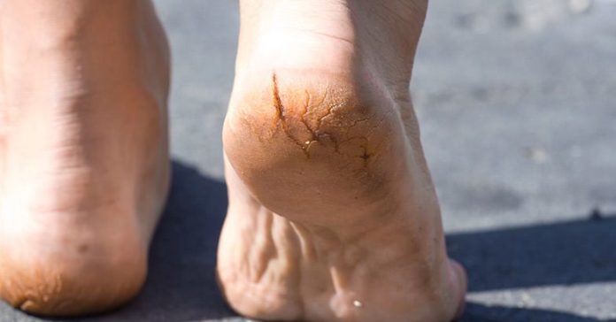 how to Treat cracked feet and heels