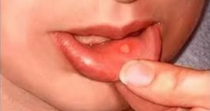 home remedy for mouth ulcers