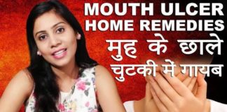 मुंह के छाले का घरेलू उपाय home remedy for mouth ulcers