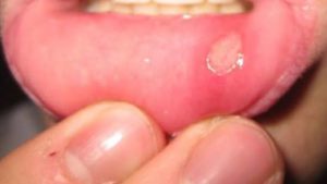 home remedy for mouth ulcers
