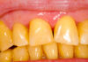 पीले दांतो को सफेद करने का इलाज Yellow teeth whitening treatment