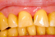 पीले दांतो को सफेद करने का इलाज Yellow teeth whitening treatment