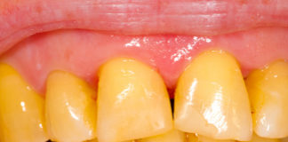 Yellow teeth whitening treatment