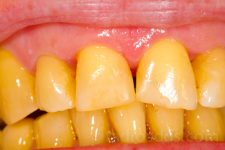 Yellow teeth whitening treatment