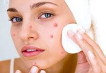 Home Remedies for Pimples Removal