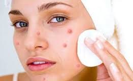 Home Remedies for Pimples Removal