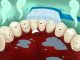 तंबाकू और गुटखा खाने से आपके भी दांत हो गए खऱाब, तो अपनाए ये टिप्स tips for cleaning teeth for people eating tobacco and gutkha