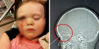 खेलने के दौरान बच्चे की आंख को चीरती हुई दिमाग तक जा पहुंची पेंसिल, फिर हुआ यह चमत्कार….. During the play, the pencil reached the mind of the child, and then this miracle happened