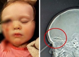 खेलने के दौरान बच्चे की आंख को चीरती हुई दिमाग तक जा पहुंची पेंसिल, फिर हुआ यह चमत्कार….. During the play, the pencil reached the mind of the child, and then this miracle happened